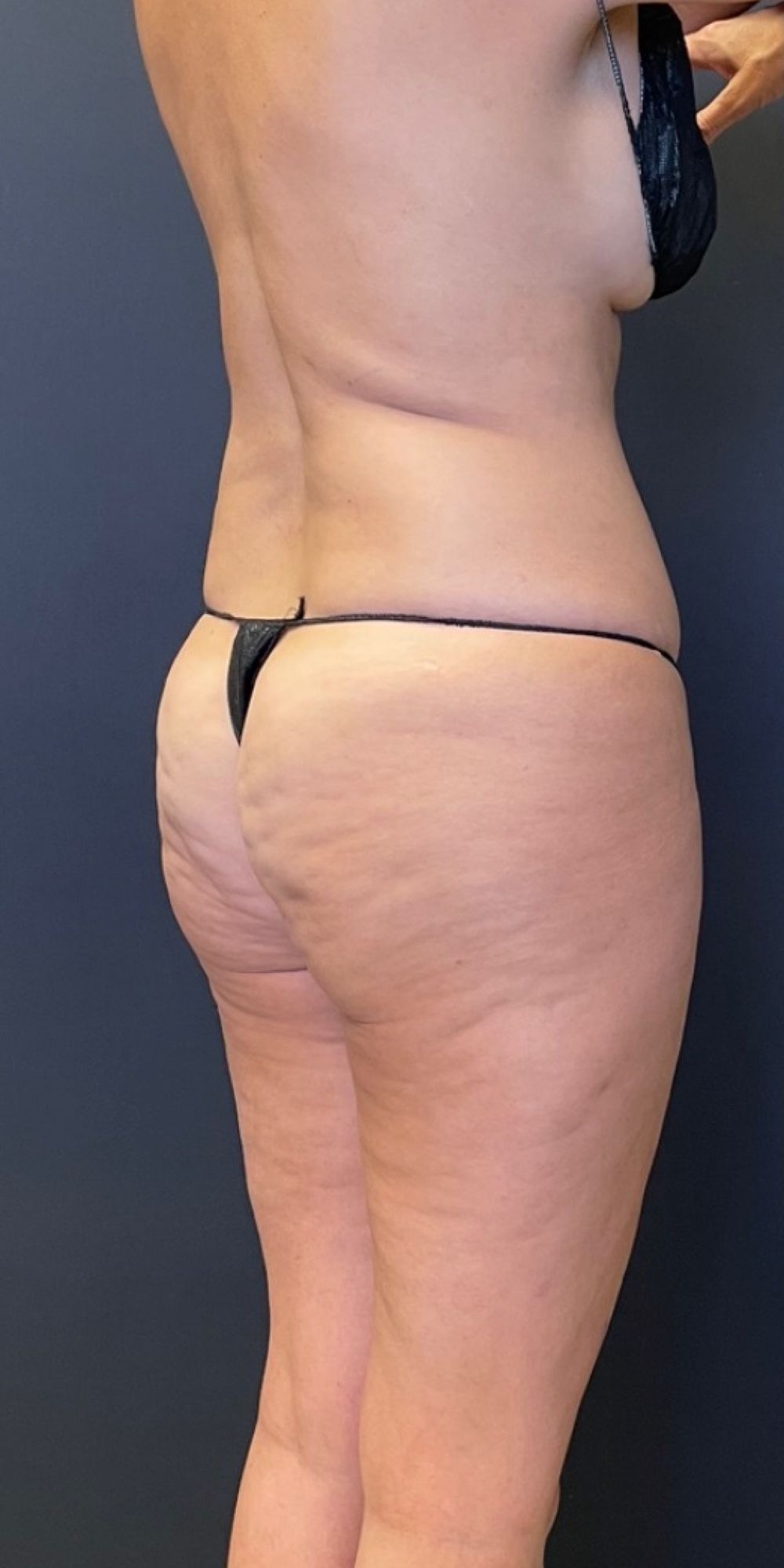 brazilian butt lift before and after pictures