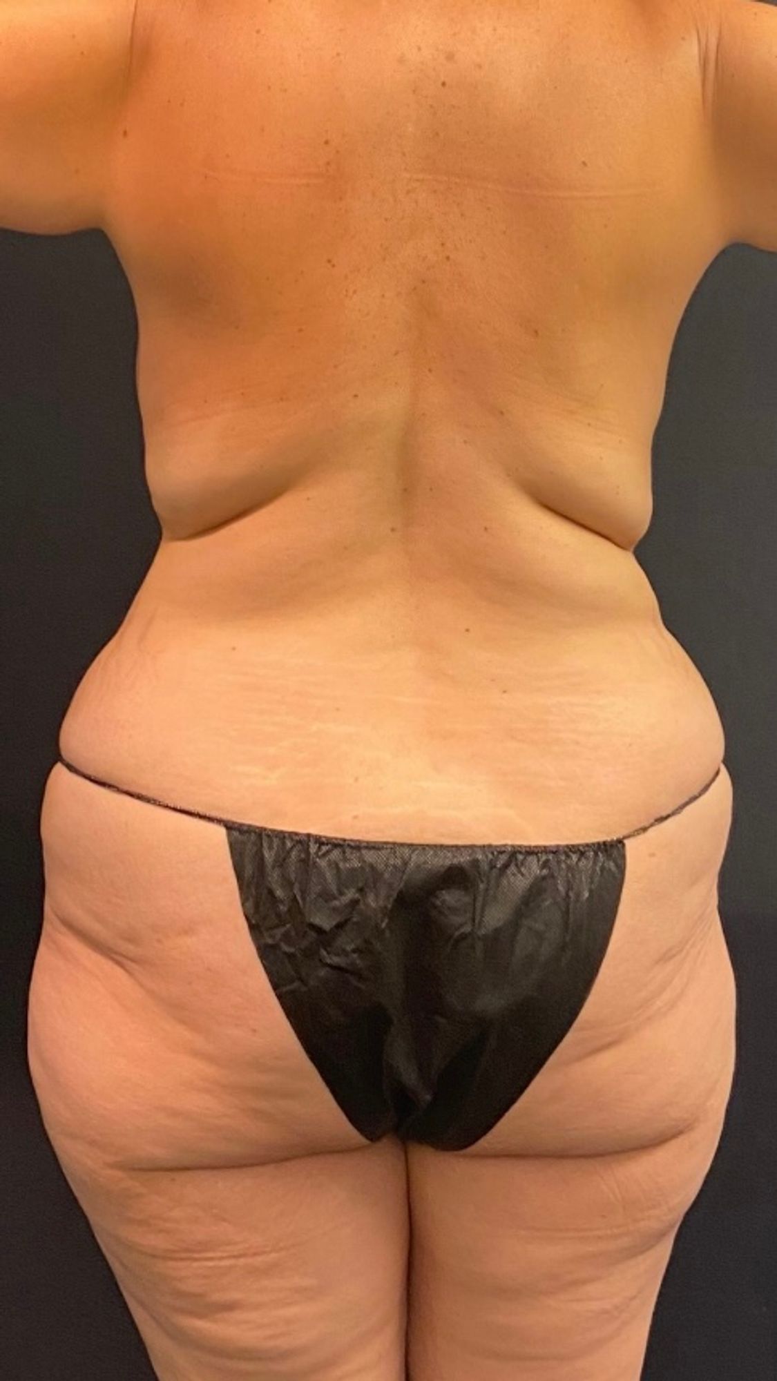 Buttock Augmentation Enhancement Risks Rancho Mirage CA Dr 90210 Plastic  Surgery