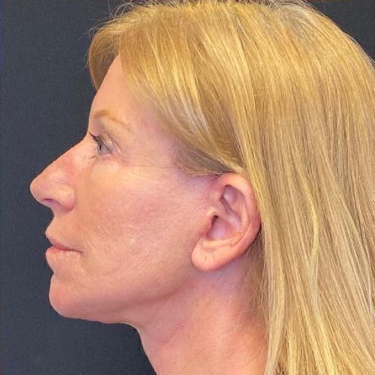 Deep Plane Facelift Before & After Image