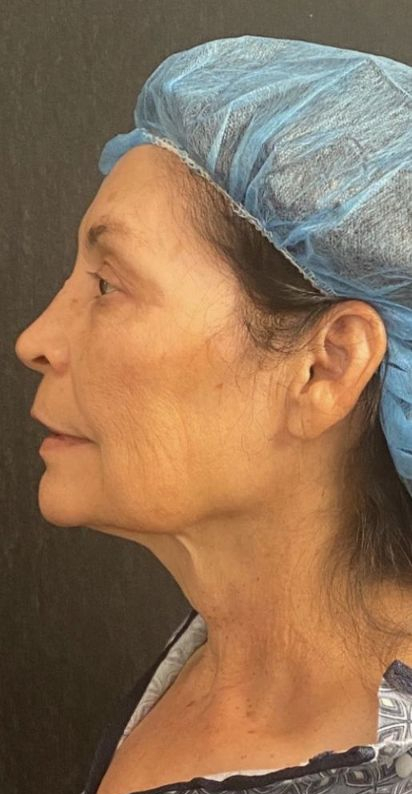 Deep Plane Facelift Before & After Image