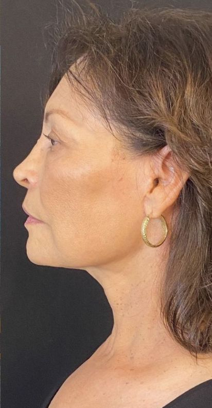 Deep Plane Facelift Before & After Image