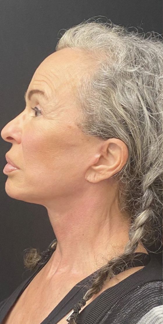 Deep Plane Facelift Before & After Image