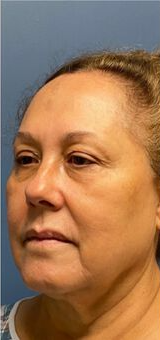 Deep Plane Facelift Before & After Image