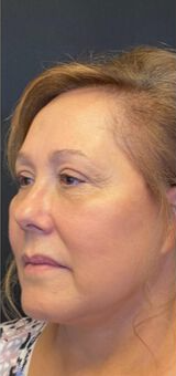 Deep Plane Facelift Before & After Image