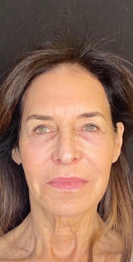 Deep Plane Facelift Before & After Image