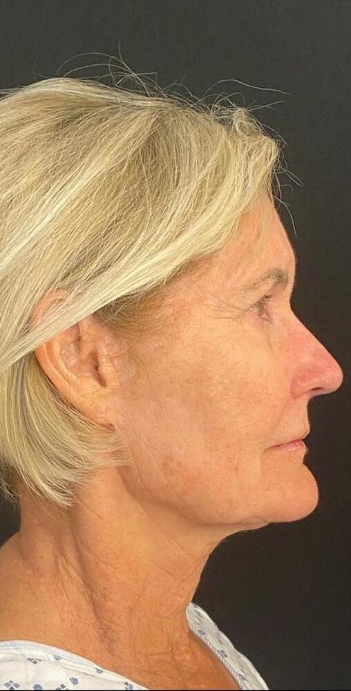 Deep Plane Facelift Before & After Image