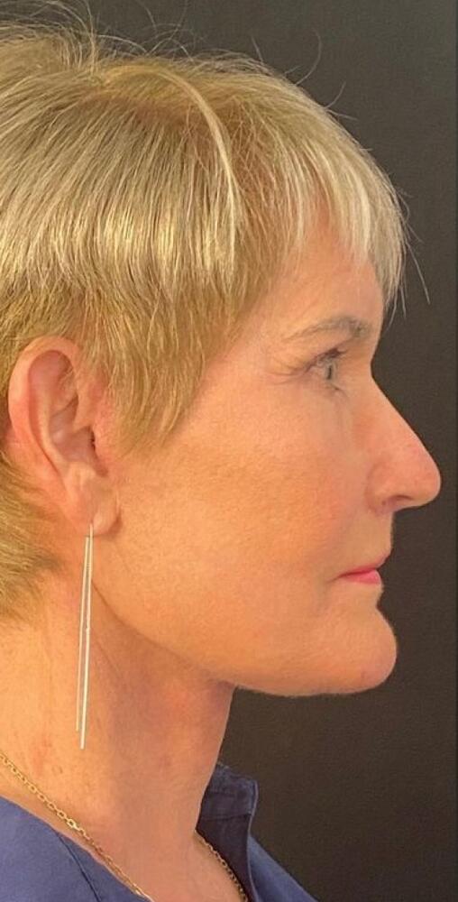 Deep Plane Facelift Before & After Image