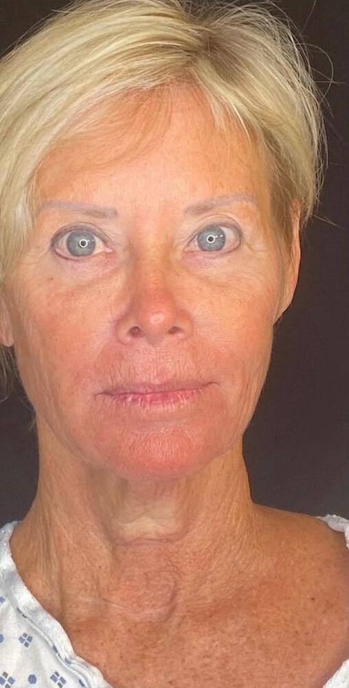 Deep Plane Facelift Before & After Image