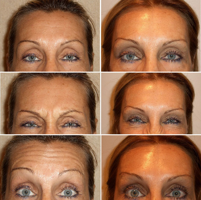 Botox forehead injections before and after photo