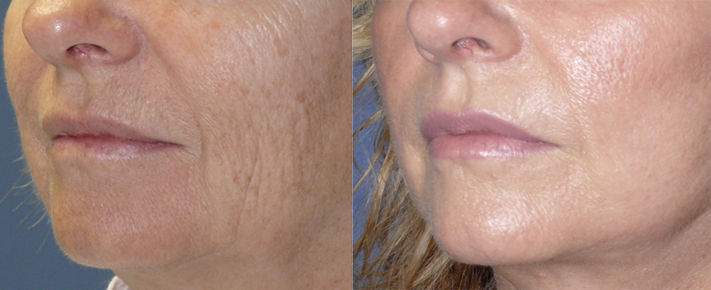 Fractional C02 Laser Before and After Photo