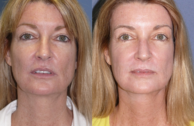 Fractional C02 Laser Before and After Photo